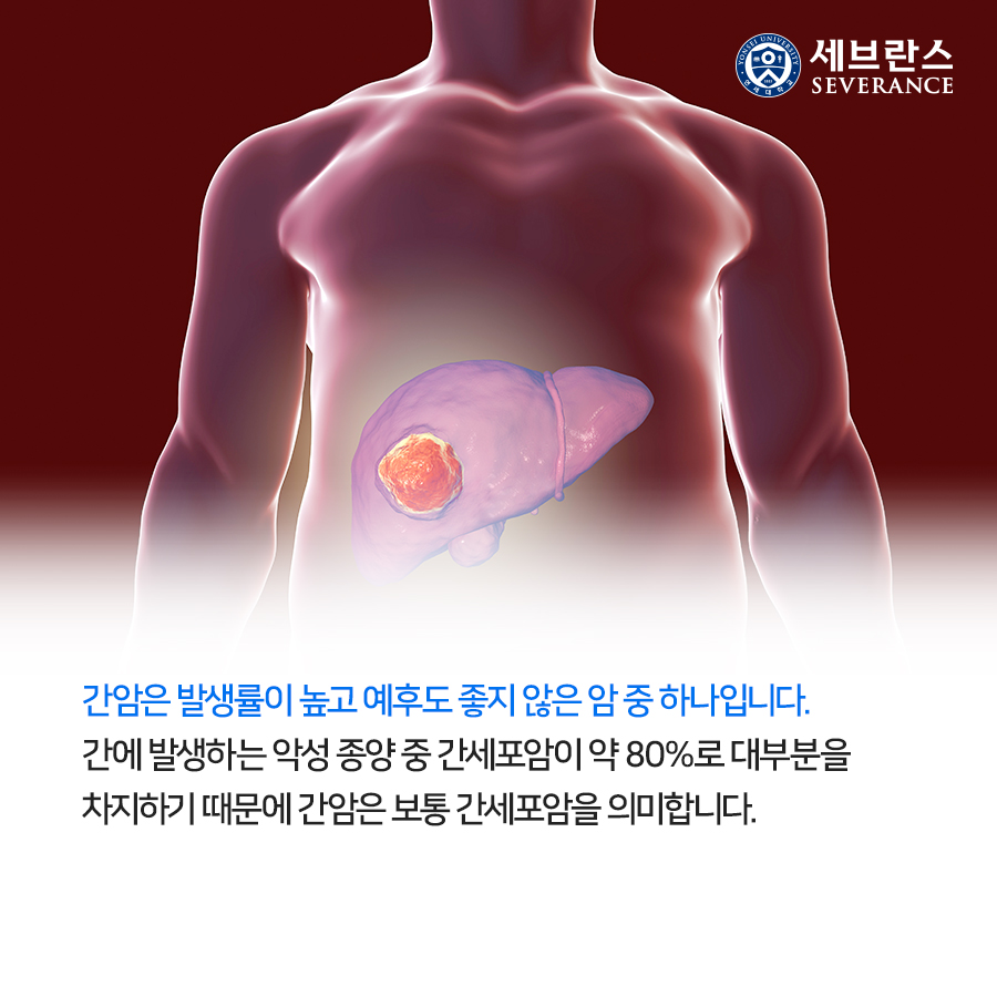 간암은 발생률이 높고 예후도 좋지 않은 암 중 하나입니다. 간에 발생하는 악성 종양 중 간세포암이 약 80%로 대부분을 차지하기 때문에 간암은 보통 간세포암을 의미합니다. 