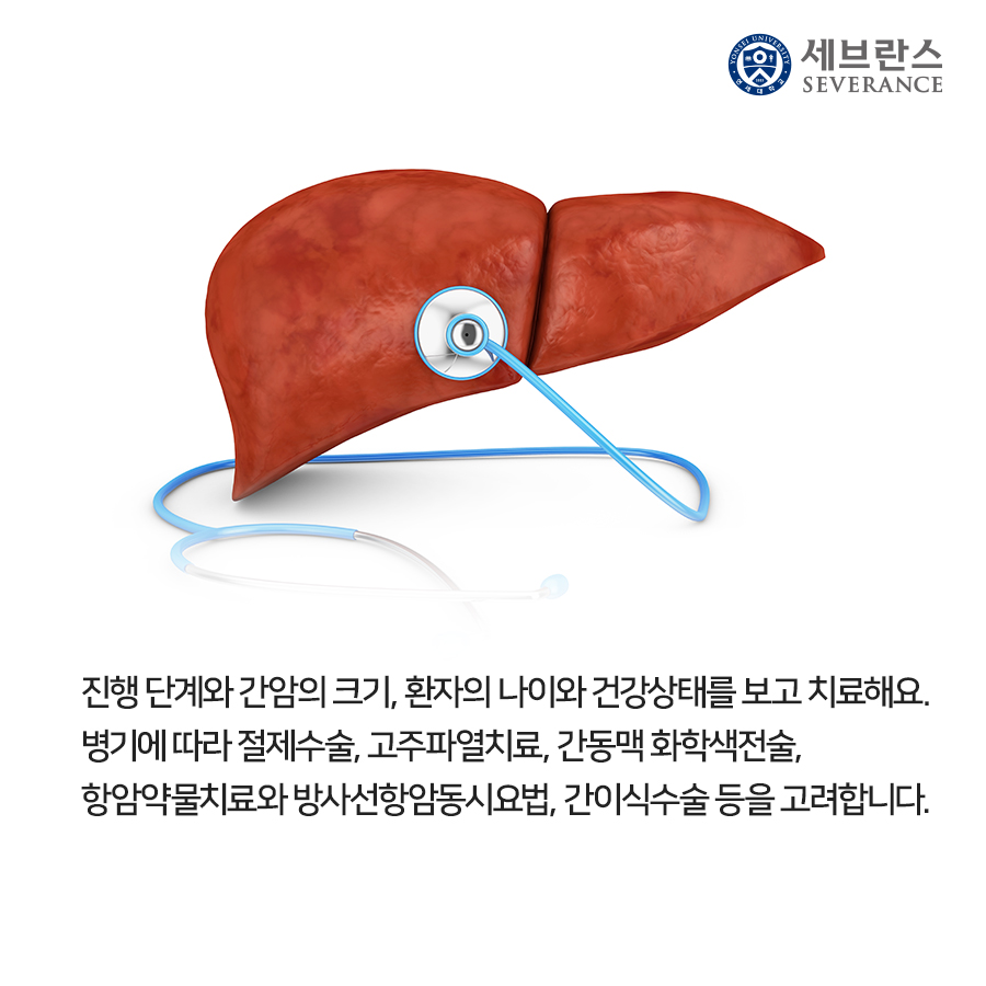 진행 단계와 간암의 크기, 환자의 나이와 건강상태를 보고 치료해요. 병기에 따라 절제수술, 고주파열치료, 간동맥 화학색전술, 항암약물치료와 방사선항암동시요법, 간이식수술 등을 고려합니다.