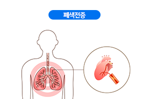 폐색전증